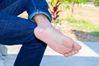 Causes and Treatment of Plantar Warts