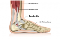 An Achilles Tendon Rupture Can Be a Debilitating Injury
