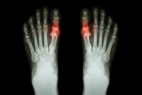 What Is Gout?