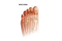 Is There a Link Between Morton’s Neuroma and Autoimmune Disease?