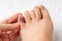 Understanding a Broken Pinky Toe