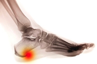 Facts About Heel Spurs